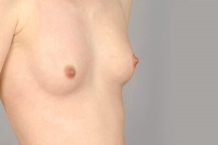 Brustvergrößerung mit Implantat vorher 